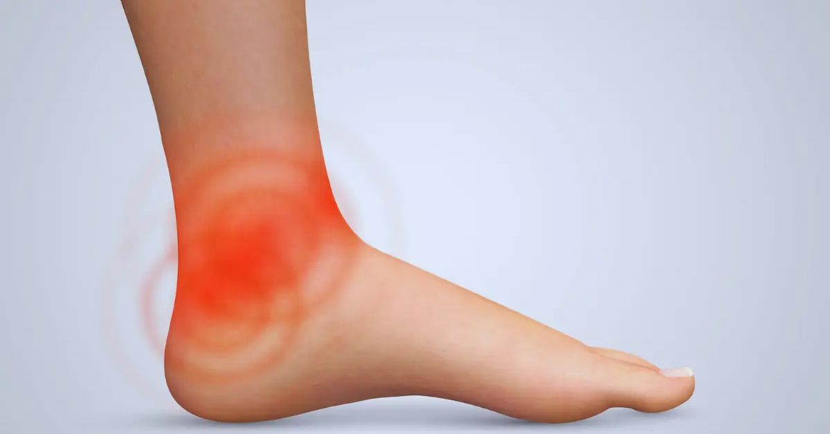 Ayak Bileği Kireçlenmesi Tedavisi